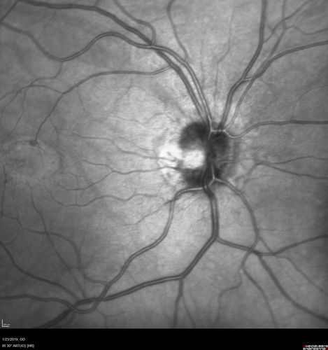 Macular Telangiectasis - Very Mild
52 year old female with normal vision and suspicious OCT referred.  Multimodal imaging shows very mild mactel (loss of macular pigment, ring on multicolor image and very mild OCT findings)

