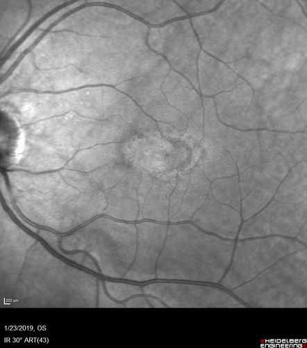 Macular Telangiectasis - Very Mild
52 year old female with normal vision and suspicious OCT referred.  Multimodal imaging shows very mild mactel (loss of macular pigment, ring on multicolor image and very mild OCT findings)
