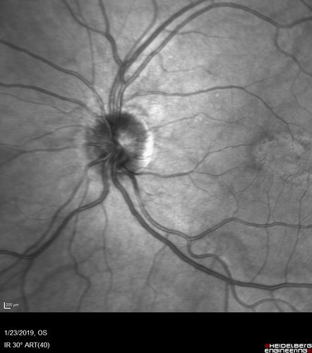 Macular Telangiectasis - Very Mild
52 year old female with normal vision and suspicious OCT referred.  Multimodal imaging shows very mild mactel (loss of macular pigment, ring on multicolor image and very mild OCT findings)
