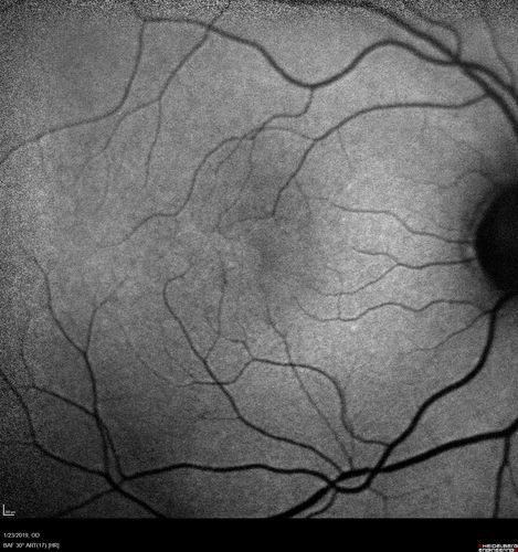 Macular Telangiectasis - Very Mild
52 year old female with normal vision and suspicious OCT referred.  Multimodal imaging shows very mild mactel (loss of macular pigment, ring on multicolor image and very mild OCT findings)
