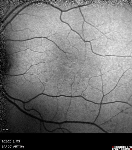 Macular Telangiectasis - Very Mild
52 year old female with normal vision and suspicious OCT referred.  Multimodal imaging shows very mild mactel (loss of macular pigment, ring on multicolor image and very mild OCT findings)
