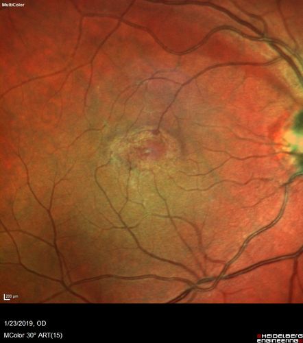 Macular Telangiectasis - Very Mild
52 year old female with normal vision and suspicious OCT referred.  Multimodal imaging shows very mild mactel (loss of macular pigment, ring on multicolor image and very mild OCT findings)
