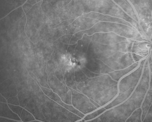 Juxtafoveal Telangiectasis and Newly Decreasing Vision
70-year-old woman followed for 10 years with IJFT with newly decreasing vision OU  OD:  20/160;  OD:  20/80
Keywords: mactel;juxtafoveal telangiectasis;telangectasia;crystals