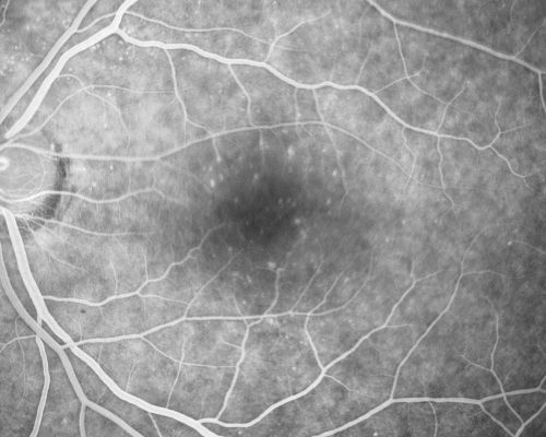 Juxtafoveal Telangiectasis and Newly Decreasing Vision
70-year-old woman followed for 10 years with IJFT with newly decreasing vision OU  OD:  20/160;  OD:  20/80
Keywords: mactel;juxtafoveal telangiectasis;telangectasia;crystals