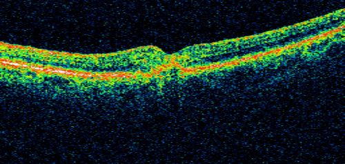 Juxtafoveal Telangiectasis and Newly Decreasing Vision
70-year-old woman followed for 10 years with IJFT with newly decreasing vision 
Keywords: mactel;juxtafoveal telangiectasis;telangectasia;crystals