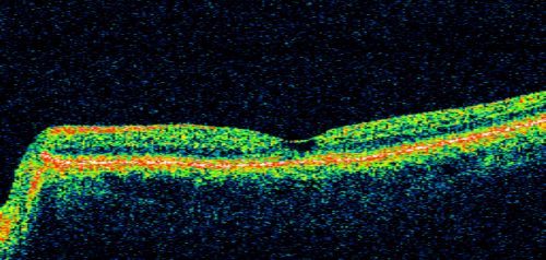 Juxtafoveal Telangiectasis and Newly Decreasing Vision
70-year-old woman followed for 10 years with IJFT with newly decreasing vision OU  OD:  20/160;  OD:  20/80
Keywords: mactel;juxtafoveal telangiectasis;telangectasia;crystals
