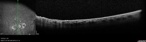 Retinoschisis - Superotemporally
Some line scans show RD and some showed retinoschisis.  Might have underlying RD that re-attached itself.
