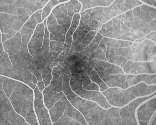 Idiopathic Cystoid Macular Edema - CME - Responded to Subtenons Kenalog - Early Fluorescein Showing Dilated Capillaries
49-year-old man had a flu two weeks ago the right eye has been throbbing and his vision in the right eye has been foggy.  OD 20/80, OS 20/40.   IOP:  14 OU.  

Keywords: cme;cystoid macular edema;steroids;idiopathic