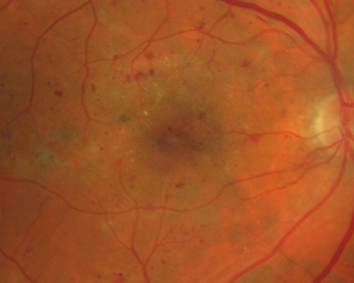 BDR and Diabetic Macular Edema with Fresh Laser Right Eye
60-year old man OD 20/60, OS 20/50 worsening vision both eyes
