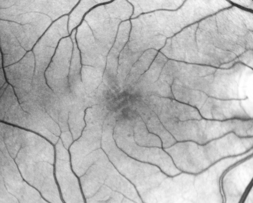 Idiopathic Cystoid Macular Edema - CME - Responded to Subtenons Kenalog - Red Free Photos Shows Foveal Cysts
49-year-old man had a flu two weeks ago the right eye has been throbbing and his vision in the right eye has been foggy.  OD 20/80, OS 20/40.   IOP:  14 OU.  

Võtmesõnad: cme;cystoid macular edema;steroids;idiopathic