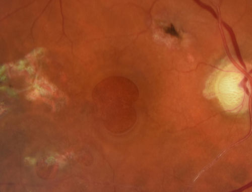 Macular Damage post Macular Hole Surgery
There is a huge hole in the middle of the macula and several small holes in the posterior pole.  The patient had 2 surgeries for an idiopathic stage II hole and then was offered a third procedure by the same surgeon and sought a second opinion (and was told to not have anything more done)
