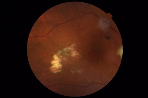 Macular Damage post Macular Hole Surgery
There is a huge hole in the middle of the macula and several small holes in the posterior pole.  The patient had 2 surgeries for an idiopathic stage II hole and then was offered a third procedure by the same surgeon and sought a second opinion (and was told to not have anything more done)
