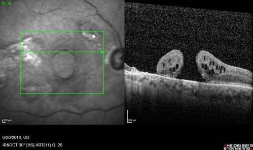 Macular Damage post Macular Hole Surgery
There is a huge hole in the middle of the macula and several small holes in the posterior pole.  The patient had 2 surgeries for an idiopathic stage II hole and then was offered a third procedure by the same surgeon and sought a second opinion (and was told to not have anything more done)
