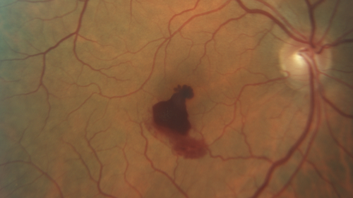 Valsalva Retinopathy - Macular Hemorrhage - Permanent Vision loss - Intraretinal Blood
65 year old man with sudden vision loss in the right eye. Initial vision 20/200.  VA improved to 20/50 in one year.  Had carotid stenosis
