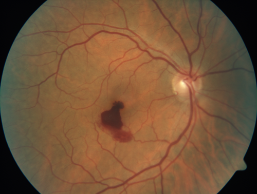 Valsalva Retinopathy - Macular Hemorrhage - Permanent Vision loss - Intraretinal Blood
65 year old man with sudden vision loss in the right eye. Initial vision 20/200.  VA improved to 20/50 in one year.  Had carotid stenosis
