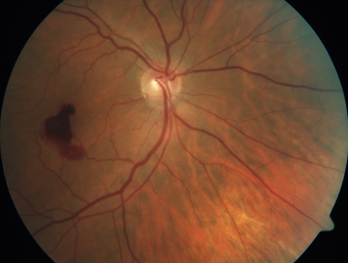 Valsalva Retinopathy - Macular Hemorrhage - Permanent Vision loss - Intraretinal Blood
65 year old man with sudden vision loss in the right eye. Initial vision 20/200.  VA improved to 20/50 in one year.  Had carotid stenosis
