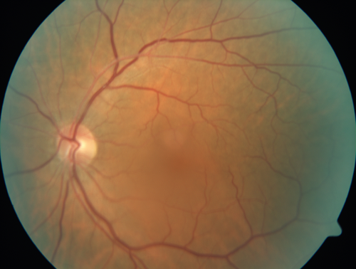 Normal Left eye
Left eye of patient with valsalva retinopathy in the right
