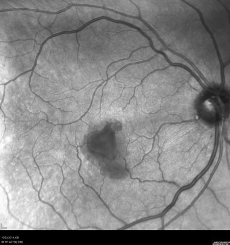 Valsalva Retinopathy - Macular Hemorrhage - Permanent Vision loss - Intraretinal Blood
65 year old man with sudden vision loss in the right eye. Initial vision 20/200.  VA improved to 20/50 in one year.  Had carotid stenosis

