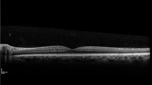 Valsalva Retinopathy - Macular Hemorrhage - Permanent Vision loss - Intraretinal Blood
65 year old man with sudden vision loss in the right eye. Initial vision 20/200.  VA improved to 20/50 in one year.  Had carotid stenosis
