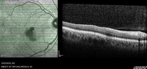 Valsalva Retinopathy - Macular Hemorrhage - Permanent Vision loss - Intraretinal Blood
65 year old man with sudden vision loss in the right eye. Initial vision 20/200.  VA improved to 20/50 in one year.  Had carotid stenosis
