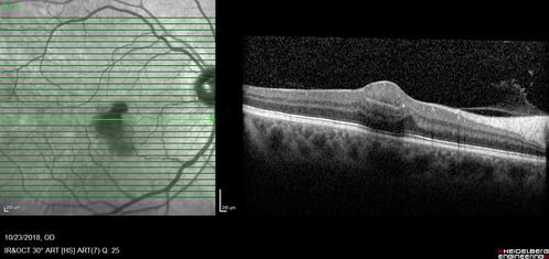 Valsalva Retinopathy - Macular Hemorrhage - Permanent Vision loss - Intraretinal Blood
65 year old man with sudden vision loss in the right eye. Initial vision 20/200.  VA improved to 20/50 in one year.  Had carotid stenosis
