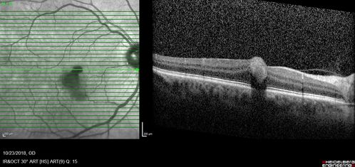 Valsalva Retinopathy - Macular Hemorrhage - Permanent Vision loss - Intraretinal Blood
65 year old man with sudden vision loss in the right eye. Initial vision 20/200.  VA improved to 20/50 in one year.  Had carotid stenosis
