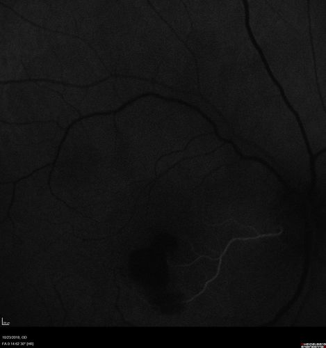 Valsalva Retinopathy - Macular Hemorrhage - Permanent Vision loss - Intraretinal Blood
65 year old man with sudden vision loss in the right eye. Initial vision 20/200.  VA improved to 20/50 in one year.  Had carotid stenosis
