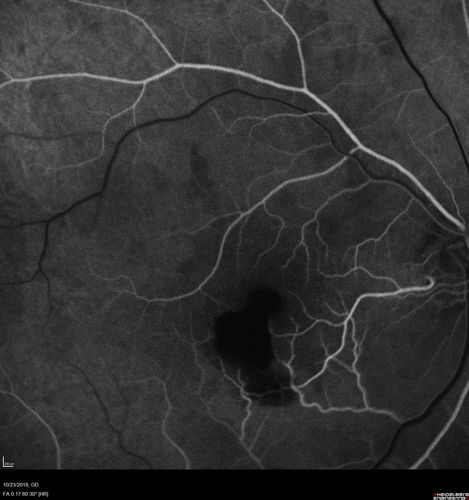 Valsalva Retinopathy - Macular Hemorrhage - Permanent Vision loss - Intraretinal Blood
65 year old man with sudden vision loss in the right eye. Initial vision 20/200.  VA improved to 20/50 in one year.  Had carotid stenosis
