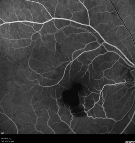 Valsalva Retinopathy - Macular Hemorrhage - Permanent Vision loss - Intraretinal Blood
65 year old man with sudden vision loss in the right eye. Initial vision 20/200.  VA improved to 20/50 in one year.  Had carotid stenosis
