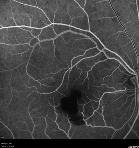 Valsalva Retinopathy - Macular Hemorrhage - Permanent Vision loss - Intraretinal Blood
65 year old man with sudden vision loss in the right eye. Initial vision 20/200.  VA improved to 20/50 in one year.  Had carotid stenosis
