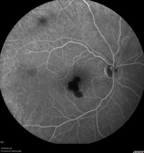 Valsalva Retinopathy - Macular Hemorrhage - Permanent Vision loss - Intraretinal Blood
65 year old man with sudden vision loss in the right eye. Initial vision 20/200.  VA improved to 20/50 in one year.  Had carotid stenosis
