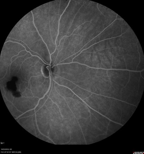 Valsalva Retinopathy - Macular Hemorrhage - Permanent Vision loss - Intraretinal Blood
65 year old man with sudden vision loss in the right eye. Initial vision 20/200.  VA improved to 20/50 in one year.  Had carotid stenosis
