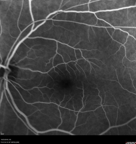 Normal Left eye
Left eye of patient with valsalva retinopathy in the right
