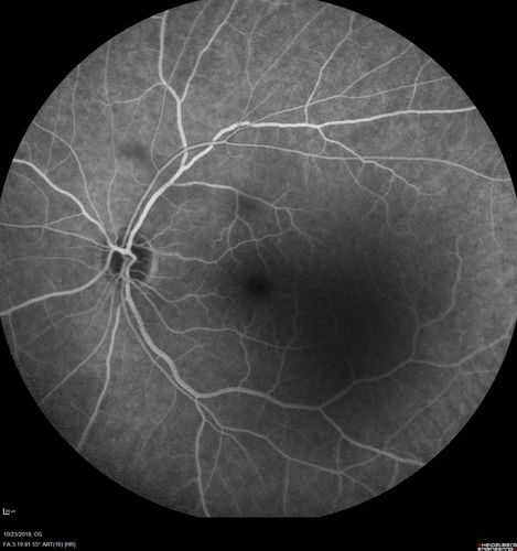 Normal Left eye
Left eye of patient with valsalva retinopathy in the right
