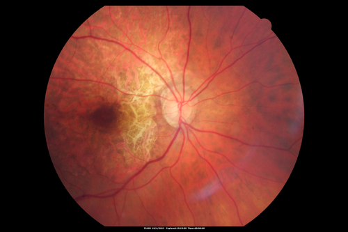 Posterior Polar Annular Choroidal Dystrophy
68 year old woman with know macular irregularities for over 20 years.  She has since been followed another 6 years and her vision remains 20/25.
