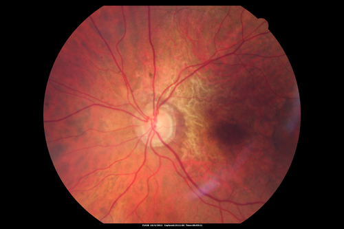 Posterior Polar Annular Choroidal Dystrophy
68 year old woman with know macular irregularities for over 20 years.  She has since been followed another 6 years and her vision remains 20/25.
