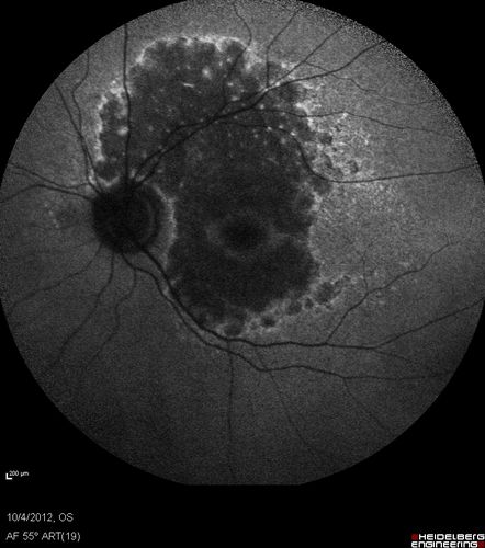 Posterior Polar Annular Choroidal Dystrophy
68 year old woman with know macular irregularities for over 20 years.  She has since been followed another 6 years and her vision remains 20/25.
