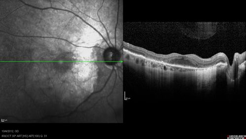 Posterior Polar Annular Choroidal Dystrophy
68 year old woman with know macular irregularities for over 20 years.  She has since been followed another 6 years and her vision remains 20/25.
