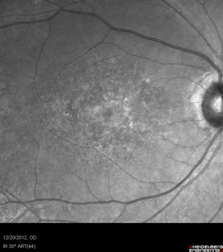Non-specific (uncharaterized / unknown) Macular Dystrophy 
59-year-old man has macular dystrophy in both eyes.  He had some vision changes in medical school in the 1980s and saw Dr. Gass for that.  He had some pigment epithelial irregularities in both eyes.  He had strabismus as a child and had muscle surgery.  He is color blind, along with many people in his family, and as far as he knows, it is congenital.
20/25, 20/30
