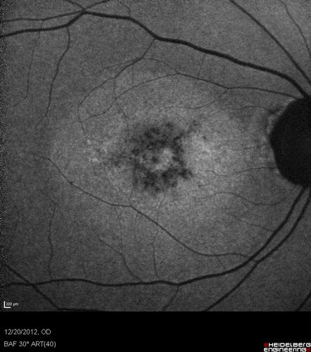 Non-specific (uncharaterized / unknown) Macular Dystrophy  - FAF
59-year-old man has macular dystrophy in both eyes.  He had some vision changes in medical school in the 1980s and saw Dr. Gass for that.  He had some pigment epithelial irregularities in both eyes.  He had strabismus as a child and had muscle surgery.  He is color blind, along with many people in his family, and as far as he knows, it is congenital.
20/25, 20/30
