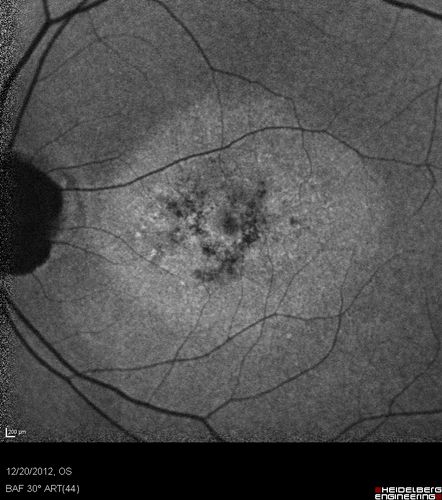 Non-specific (uncharaterized / unknown) Macular Dystrophy - FAF
59-year-old man has macular dystrophy in both eyes.  He had some vision changes in medical school in the 1980s and saw Dr. Gass for that.  He had some pigment epithelial irregularities in both eyes.  He had strabismus as a child and had muscle surgery.  He is color blind, along with many people in his family, and as far as he knows, it is congenital.
20/25, 20/30
