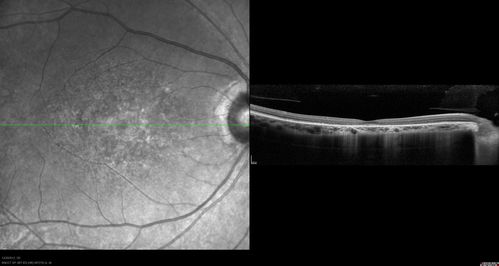 Non-specific (uncharaterized / unknown) Macular Dystrophy 
59-year-old man has macular dystrophy in both eyes.  He had some vision changes in medical school in the 1980s and saw Dr. Gass for that.  He had some pigment epithelial irregularities in both eyes.  He had strabismus as a child and had muscle surgery.  He is color blind, along with many people in his family, and as far as he knows, it is congenital.
20/25, 20/30
