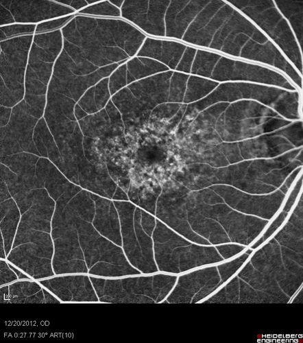 Non-specific (uncharaterized / unknown) Macular Dystrophy 
59-year-old man has macular dystrophy in both eyes.  He had some vision changes in medical school in the 1980s and saw Dr. Gass for that.  He had some pigment epithelial irregularities in both eyes.  He had strabismus as a child and had muscle surgery.  He is color blind, along with many people in his family, and as far as he knows, it is congenital.
20/25, 20/30
