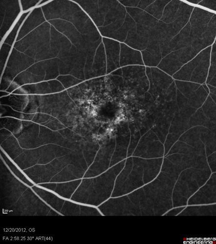 Non-specific (uncharaterized / unknown) Macular Dystrophy 
59-year-old man has macular dystrophy in both eyes.  He had some vision changes in medical school in the 1980s and saw Dr. Gass for that.  He had some pigment epithelial irregularities in both eyes.  He had strabismus as a child and had muscle surgery.  He is color blind, along with many people in his family, and as far as he knows, it is congenital.
20/25, 20/30
