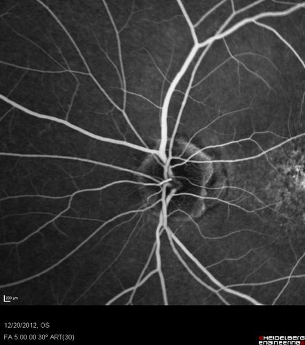 Non-specific (uncharaterized / unknown) Macular Dystrophy 
59-year-old man has macular dystrophy in both eyes.  He had some vision changes in medical school in the 1980s and saw Dr. Gass for that.  He had some pigment epithelial irregularities in both eyes.  He had strabismus as a child and had muscle surgery.  He is color blind, along with many people in his family, and as far as he knows, it is congenital.
20/25, 20/30
