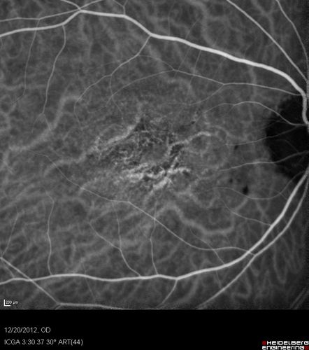 Non-specific (uncharaterized / unknown) Macular Dystrophy - ICG
59-year-old man has macular dystrophy in both eyes.  He had some vision changes in medical school in the 1980s and saw Dr. Gass for that.  He had some pigment epithelial irregularities in both eyes.  He had strabismus as a child and had muscle surgery.  He is color blind, along with many people in his family, and as far as he knows, it is congenital.
20/25, 20/30
