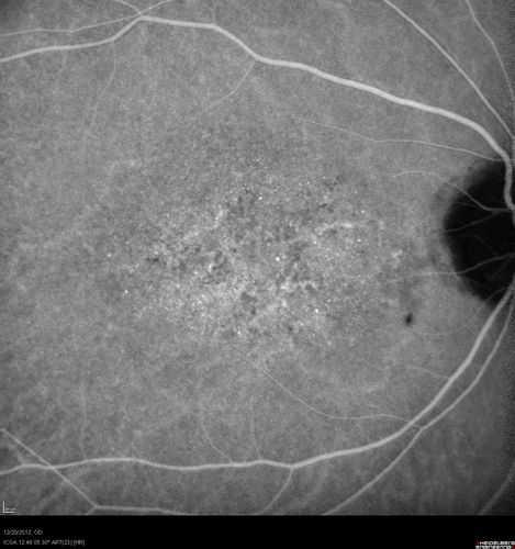 Non-specific (uncharaterized / unknown) Macular Dystrophy - ICG
59-year-old man has macular dystrophy in both eyes.  He had some vision changes in medical school in the 1980s and saw Dr. Gass for that.  He had some pigment epithelial irregularities in both eyes.  He had strabismus as a child and had muscle surgery.  He is color blind, along with many people in his family, and as far as he knows, it is congenital.
20/25, 20/30
