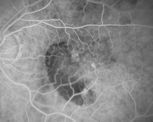 AMD - Wet - Fibrovascular Hemorrhagic PED - Occult CNVM
87-year-old woman for one month OS:  20/60 Fibrovascular PED and Hemorrhage
Keywords: ped;fibrovascular;occult;hemorrhage;wet AMD