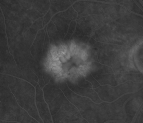 Idiopathic Cystoid Macular Edema - CME - Close up of Late Fluorescein Angiogram Showing Leakage into Foveal Cysts
49-year-old man had a flu two weeks ago the right eye has been throbbing and his vision in the right eye has been foggy.  OD 20/80, OS 20/40.   IOP:  14 OU.  

Schlüsselwörter: cme;cystoid macular edema;steroids;idiopathic;best macular acquired