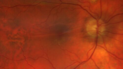 Macular fold - resolved with time
